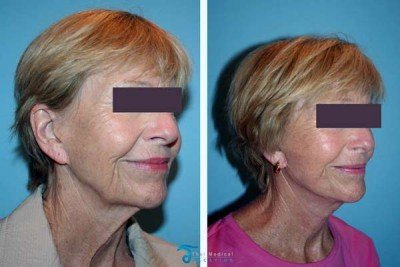 Neck-Lift-Thailand-before-after