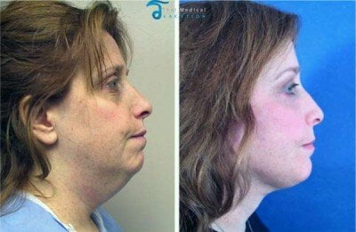 Neck-Lift-Thailand-before-after-pictures2