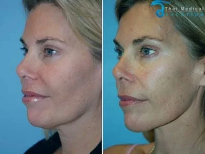 Neck-Lift-Thailand-liposuction-before-after