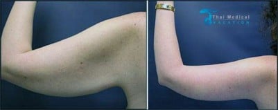 arm-lift-thailand-before-after-sue