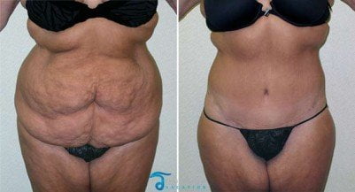 body-lift-thailand-before-after-body-contouring-thailand