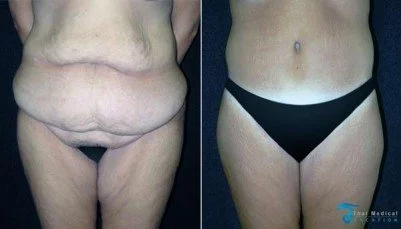 body-lift-thailand-before-after