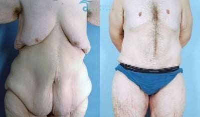 body-lift-thailand-mark-before-after-body-contouring-thailand