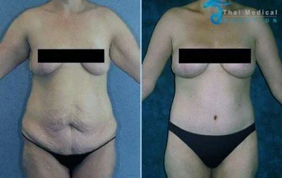 body-lift-thailand-sam-before-after-body-contouring-thailand