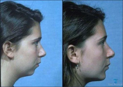 chin-implants-thailand-before-after-2