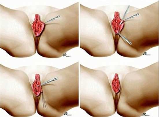 cosmetic-gynecology-thailand-Vaginal-Reconstruction