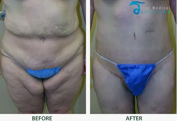 inner-thigh-lift-thailand-before-after-pictures