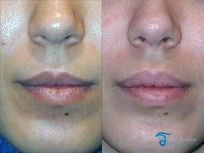 lip-lift-thailand-before-and-after