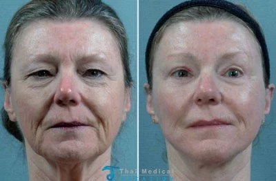 stem-cell-face-lift-in-bangkok-thailand-before-after