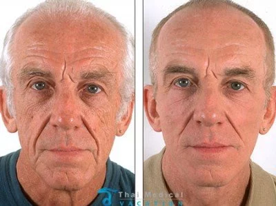 stem-cell-facelift-david-bangkok-thailand-before-after-picture
