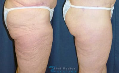 thigh-lift-bangkok-before-after-reviews