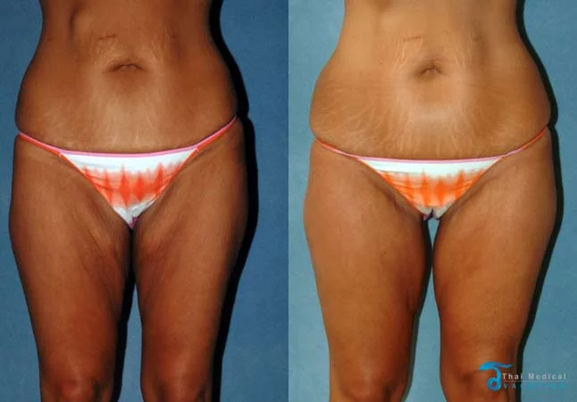 thigh-lift-thailand-before-after-pictures