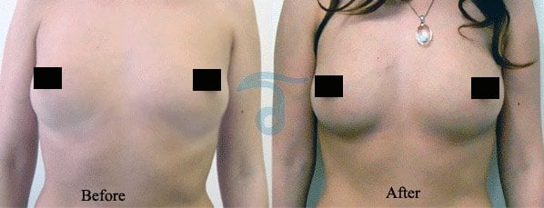 CAL-all-natural-breast-enhancement