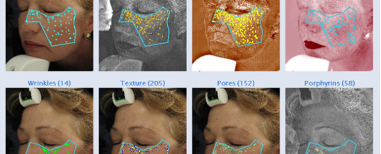 Visia Skin Scan & Complexion Analysis