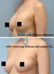 stem-cell-breast-augmentation-thailand-medical
