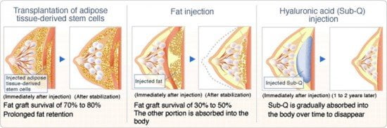 stem-cell-breast-enlargement-survival-rate-comparison