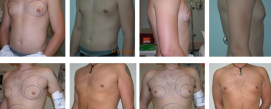 Male Chest Liposuction Thailand|Effective Solutions for Gynecomastia