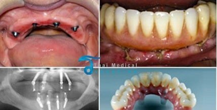 All on 4 & All on 6 Dental Implants