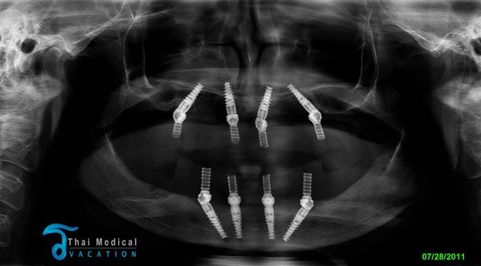 all-on-4-dental-implants-thailand