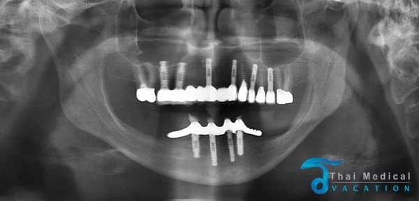 all-on-6-dental-implants-thailand
