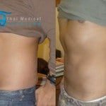 BodyTite-lipo-men-abs-thailand