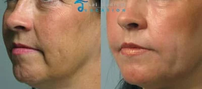 ulthera-thailand-ultherapy-before-and-after-bangkok