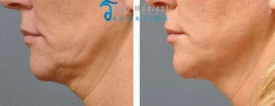 ulthera-thailand-ultherapy-before-and-after-pictures-vanessa