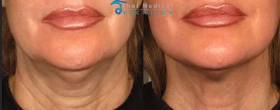 ulthera-thailand-ultherapy-necklift-skin-laser-before-and-after-pictures