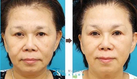 ulthera-thailand-ultherapy-non-surgical-facelift-kim