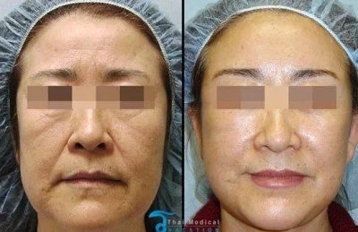 stem cell facelift non surgical facelift stem cell face lift in Thailand