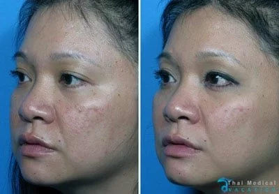 vampire-facelift-thailand-susan-before-after-prp-ha-picture
