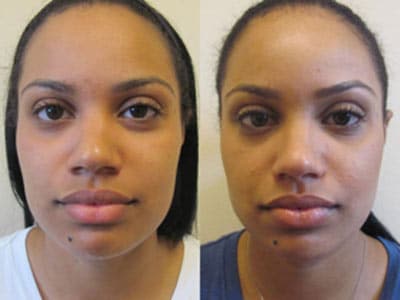 african-rhinoplasty-before-after