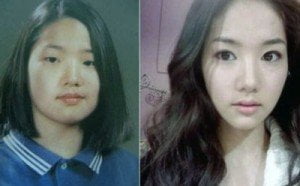 asian-ethnic-Plastic-surgery-before-after