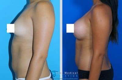 bangkok-tubular-breast-surgery-fix-Asymmetry-thailand-before-after-procedures