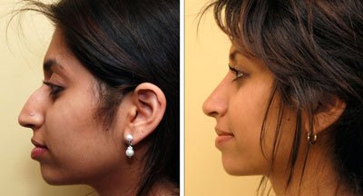 indian-rhinoplasty-before-after