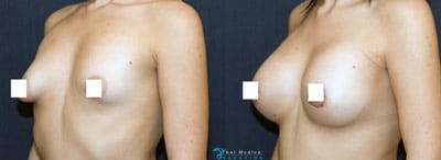 tuberous-breast-surgery-thailand-before-after-procedures