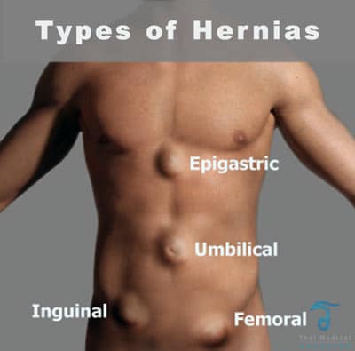 types-hernia-surgery-thailand