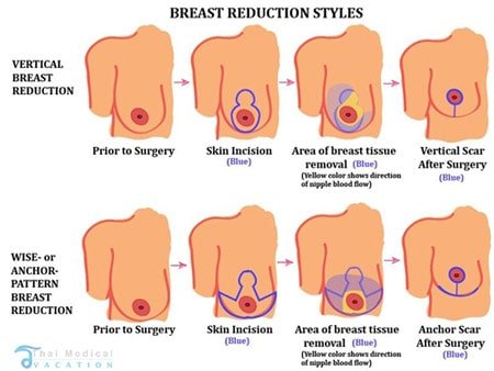 Breast-Reduction-Thailand-bangkok