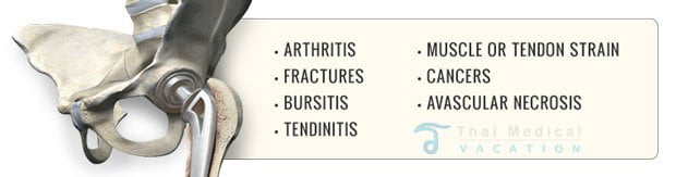 Thailand-Hip-Replacement-Surgery