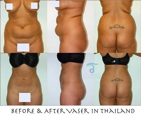 before-after-vaser-lipo-bangkok-thailand