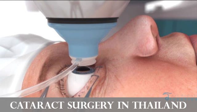 cataract-surgery-thailand-prices