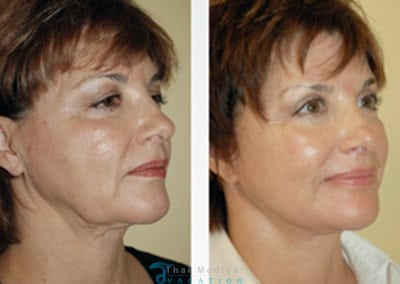 Non-Surgical CAL Stem Cell Facelift Enriched MSc Cells