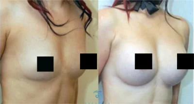 tear-drop-implants-thailand