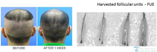 FUE-Micrograting-Transplants-thailand-before-after