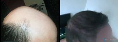 FUE-hair-restoration-thailand-edward-before-after