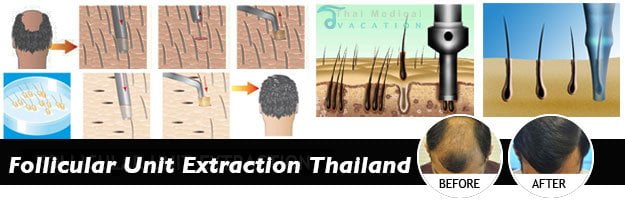 Follicular-Unit-Extraction-bangkok-thailand-before-after