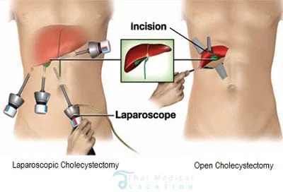 Laparoscopic-cholecystectomy-thailand