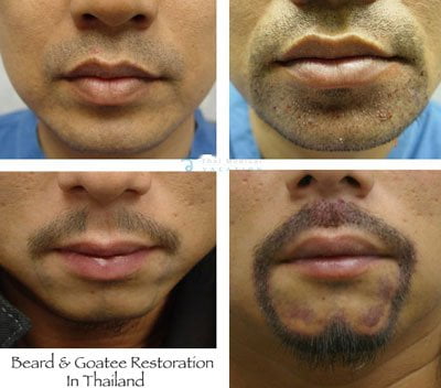 beard-goatee-transplants-facial-hair-restoration