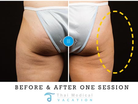coolsculpting-prices-bangkok-before-after