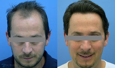 eddie-hair-restoration-prp-hairline-bangkok